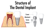 Dental Implants: A Comprehensive Guide