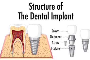 Dental Implants: A Comprehensive Guide